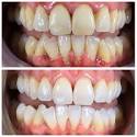 teeth cleaning before and after